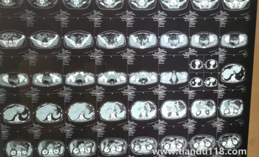 胰腺不舒服早期大便會變化嗎2