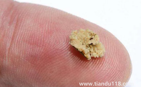 腎結(jié)石三毫米可以碎嗎2